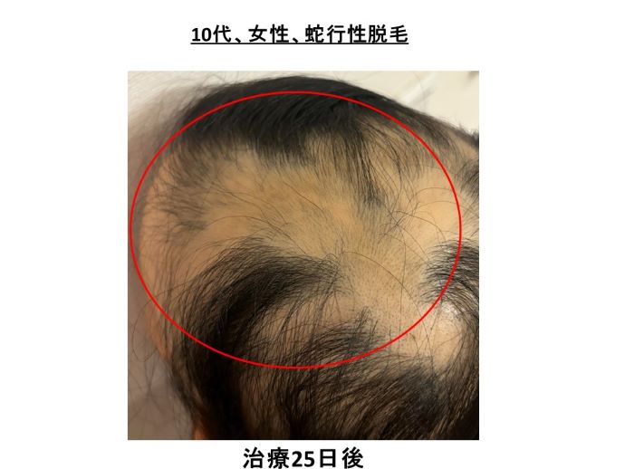 円形脱毛症　病院